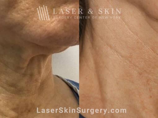 Genius microneedling to rejuvenate skin on the neck