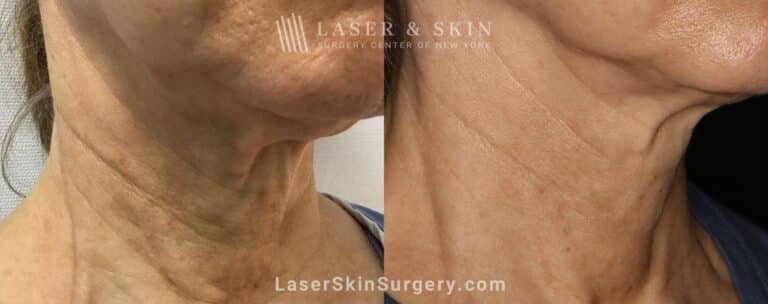 Genius microneedling to rejuvenate skin on the neck