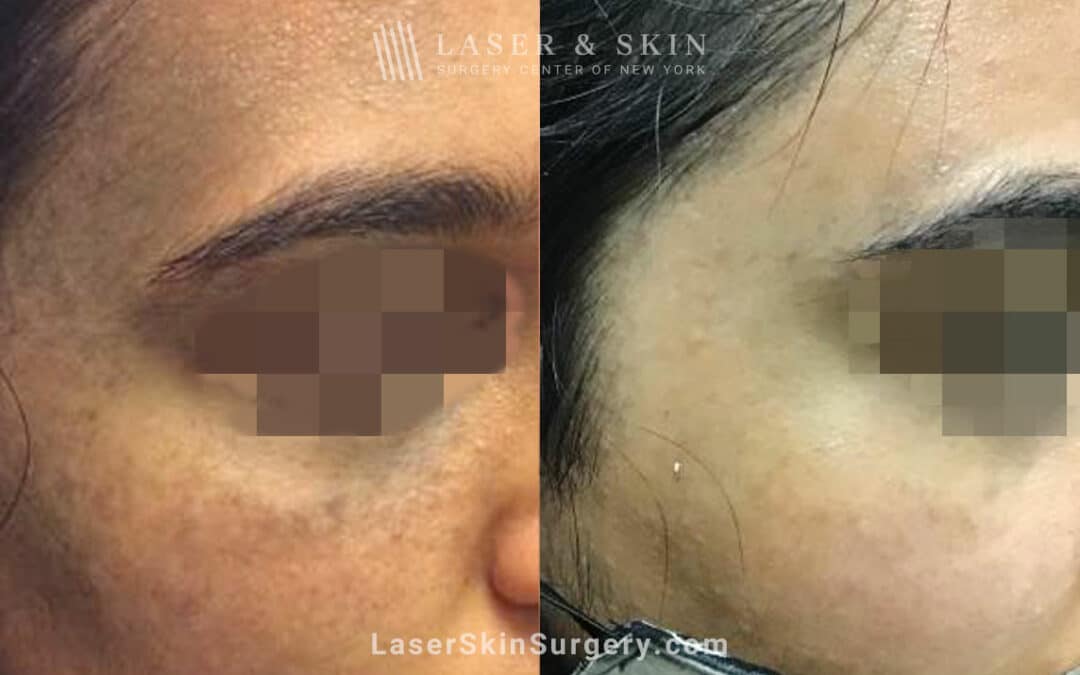 Laser Treatment for Nevus of Ota