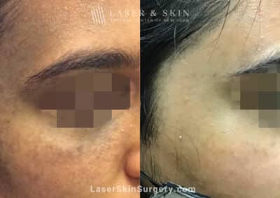 Laser Treatment for Nevus of Ota