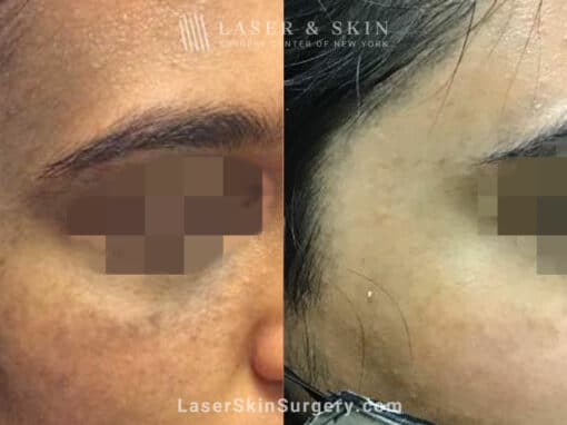 Laser Treatment for Nevus of Ota