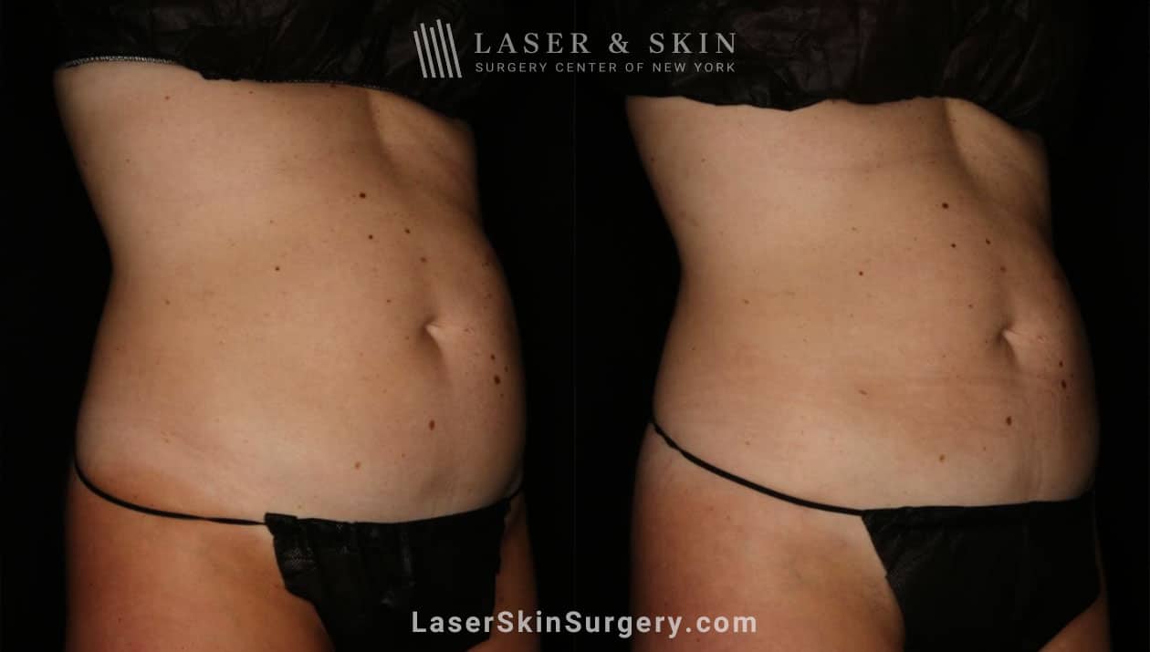 liposuction before and after