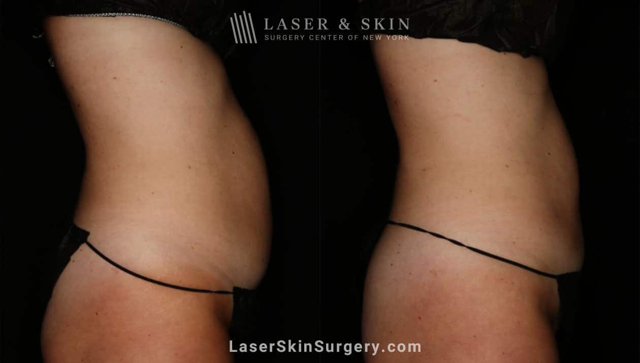 liposuction in new york