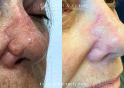 Erbium and Sciton Laser Resurfacing for Nose