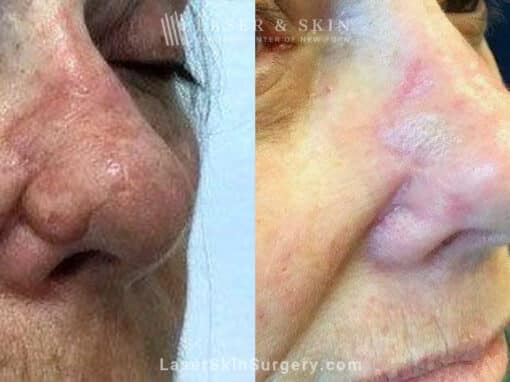 Erbium and Sciton Laser Resurfacing for Nose