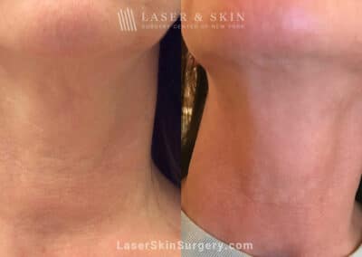 ThermiSmooth for Neck Rejuvenation