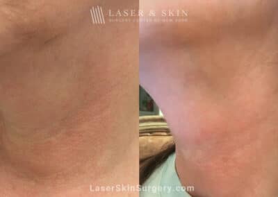 ThermiSmooth for Neck Rejuvenation