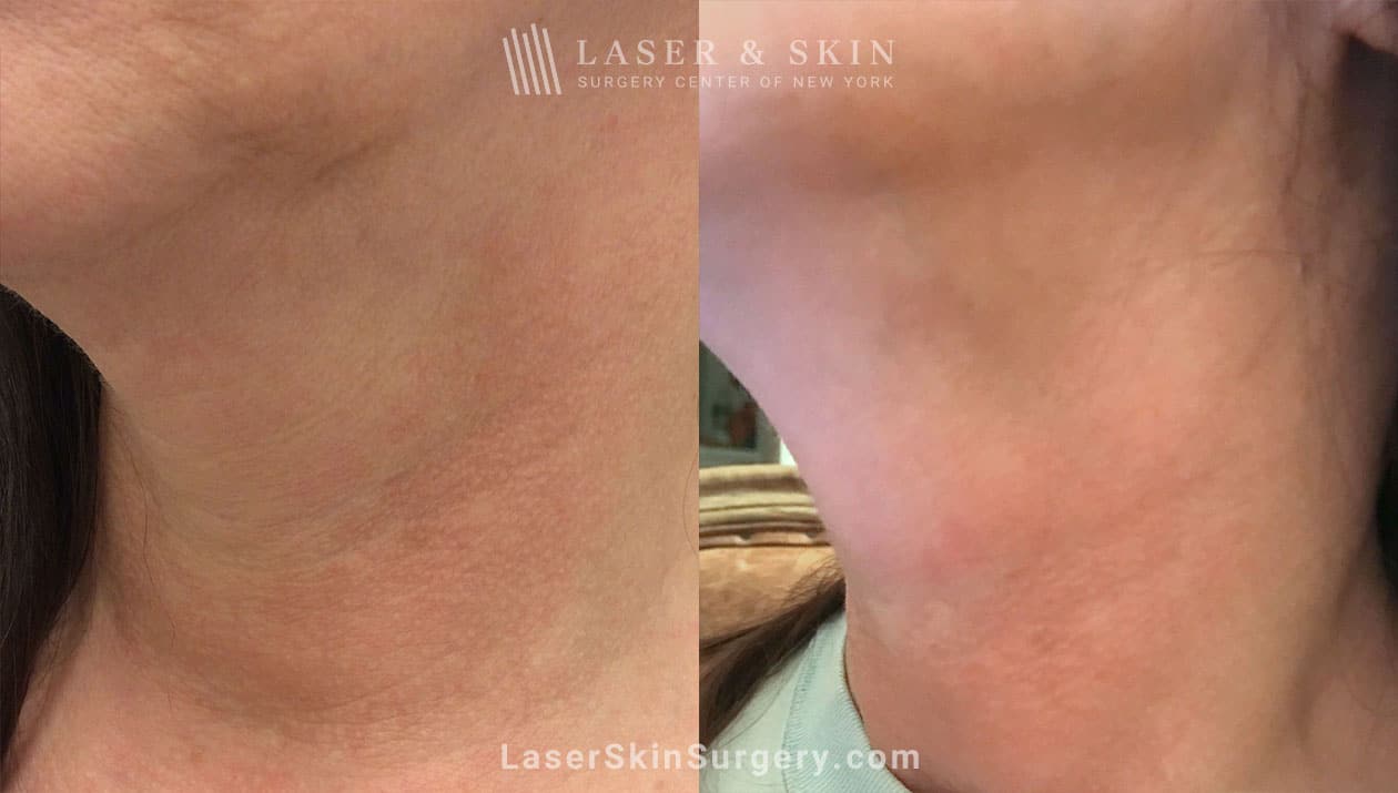 ThermiSmooth laser resurfacing treatment in NY, NY