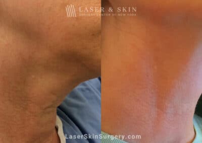 ThermiSmooth for Neck Rejuvenation