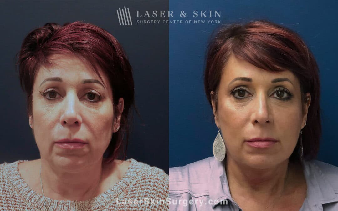 skin tightening treatment results