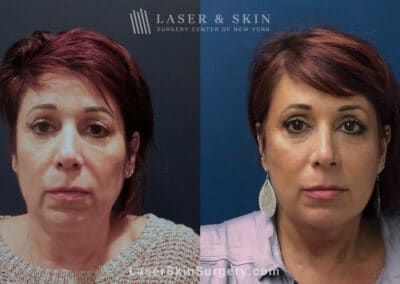 ThermiSmooth for Skin Rejuvenation