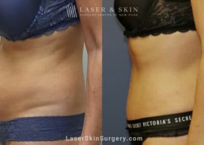 Tummy Tuck to Trim the Midsection