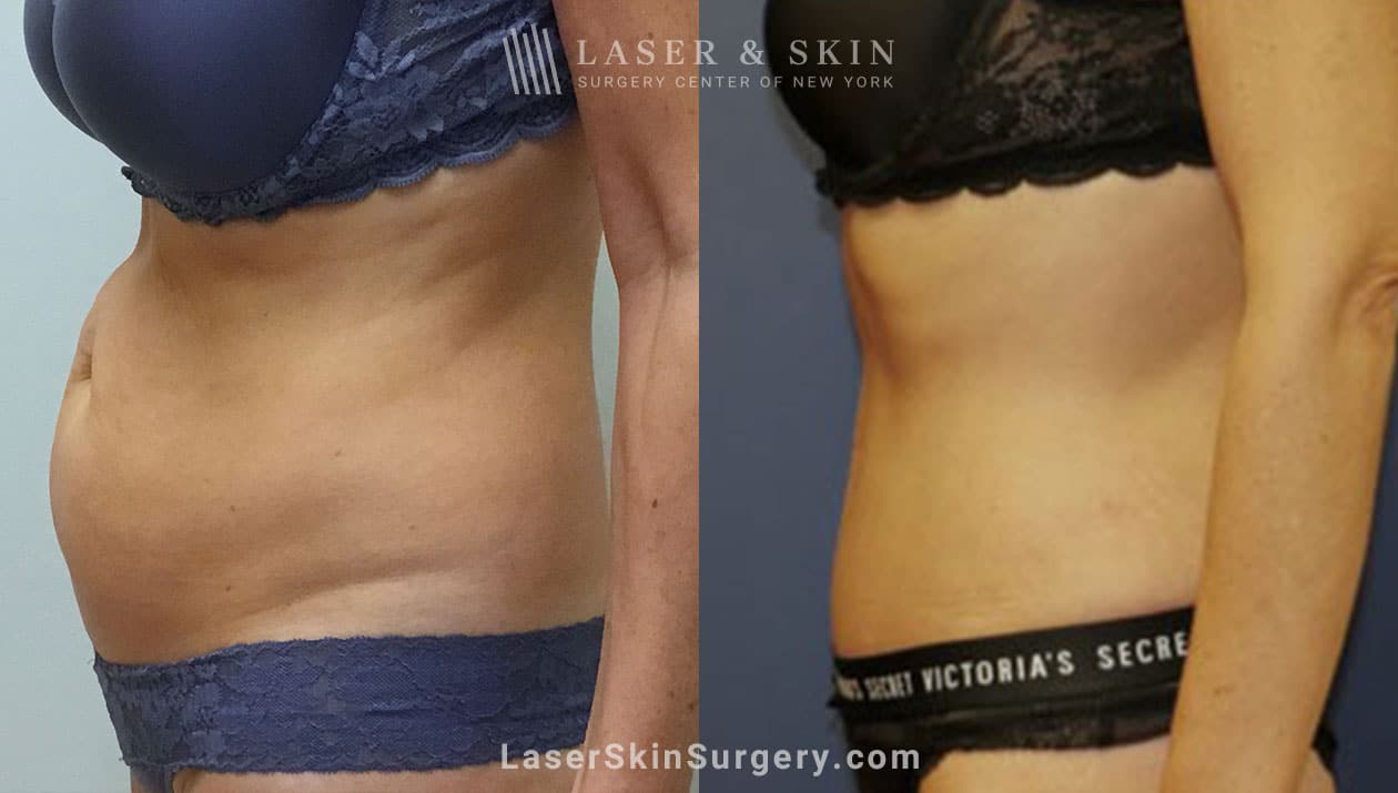 tummy tuck in new york city