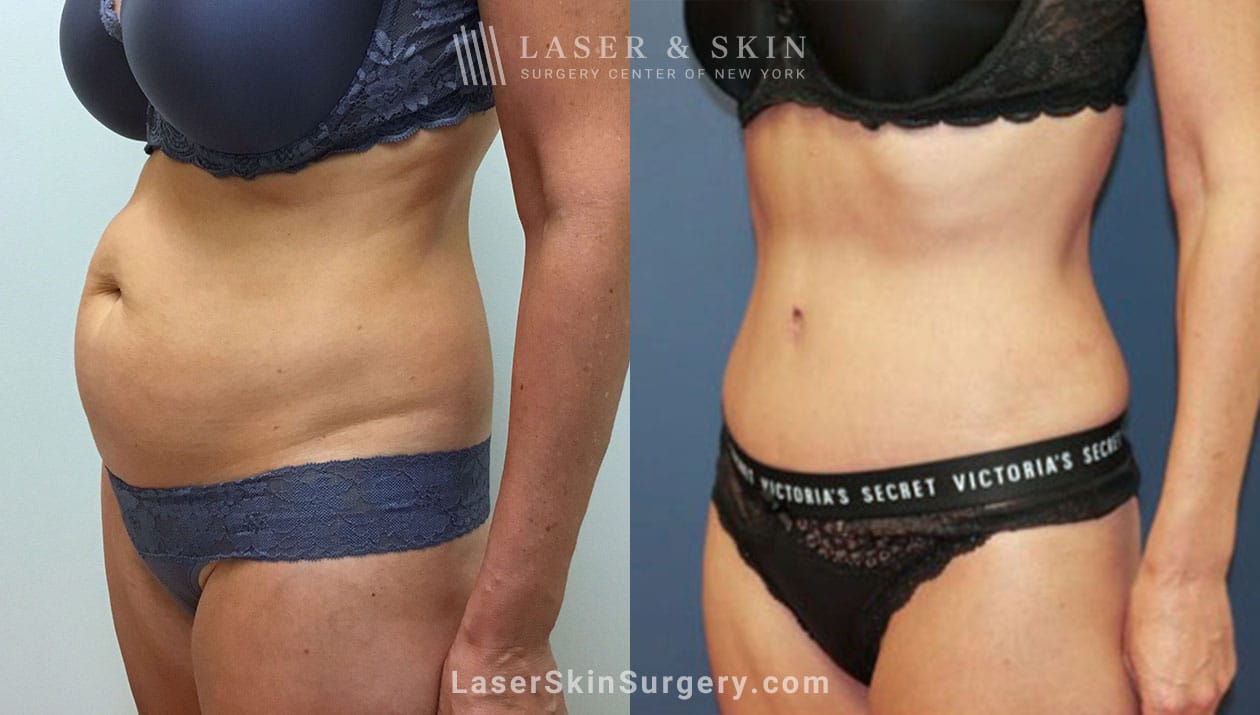 Tummy-tuck-to-trim-midsection-NYC-2 tummy tuck results