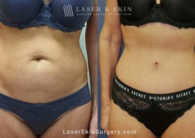 Tummy Tuck to Trim the Midsection