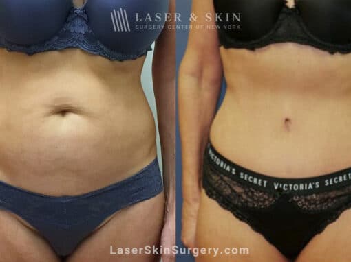 Tummy Tuck to Trim the Midsection