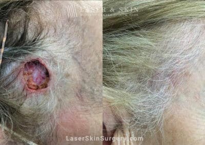 Mohs Surgery to Treat Skin Cancer on the Temple