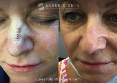 CO2 Laser to Treat Scar on Nose