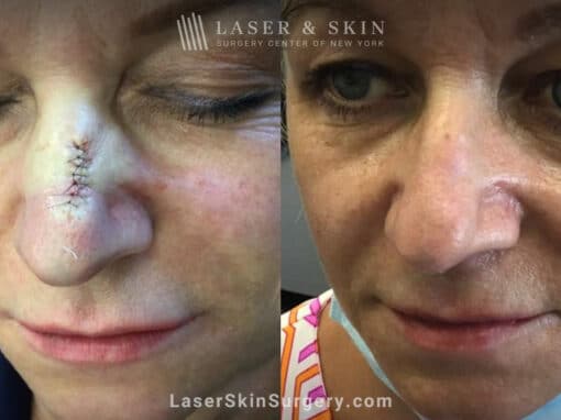 CO2 Laser to Treat Scar on Nose