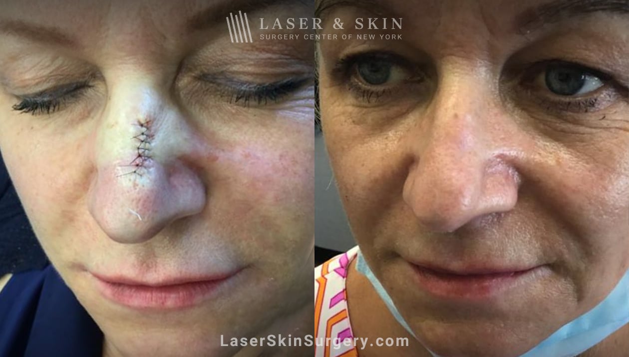CO2-laser-to-treat-scar-LSSC-NYC scar revision before and after