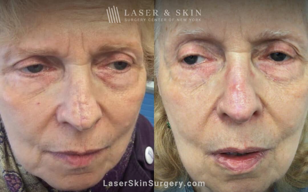CO2 Laser to Treat Nose Scar