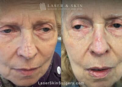 CO2 Laser to Treat Nose Scar