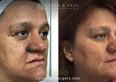 Erbium laser to treat tuberous sclerosis and angiofibromas