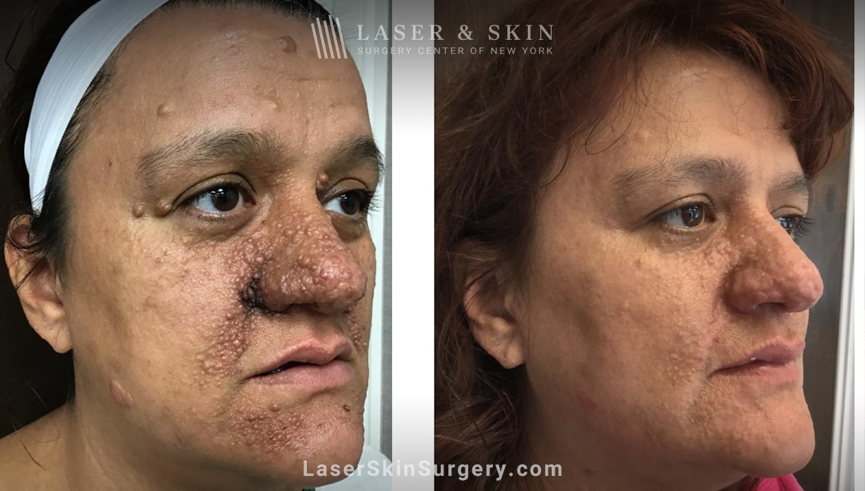 Erbium YAG Laser Scar Treatment New York, NY Laser Center