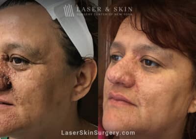 Erbium laser to treat tuberous sclerosis and angiofibromas