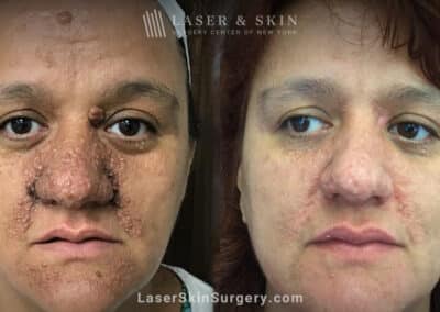 Erbium laser to treat tuberous sclerosis and angiofibromas