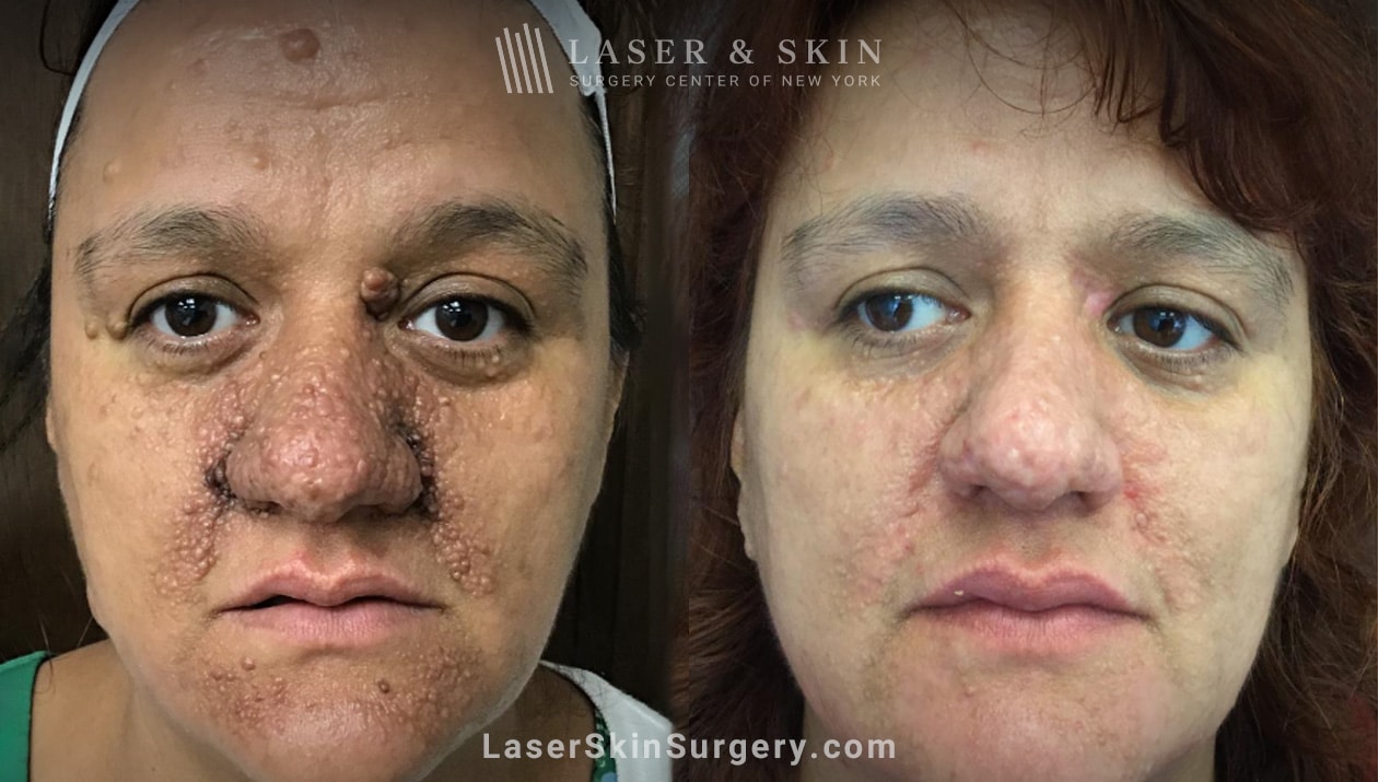 facial-tuberous-sclerosis-new-york-ny-laser-center
