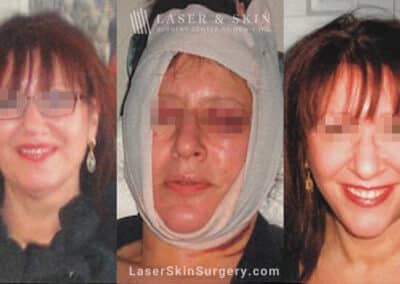 Facelift three days and three weeks after surgery