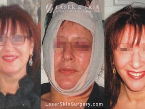 Facelift three days and three weeks after surgery