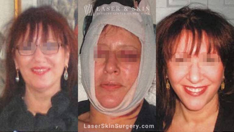 Facelift three days and three weeks after surgery