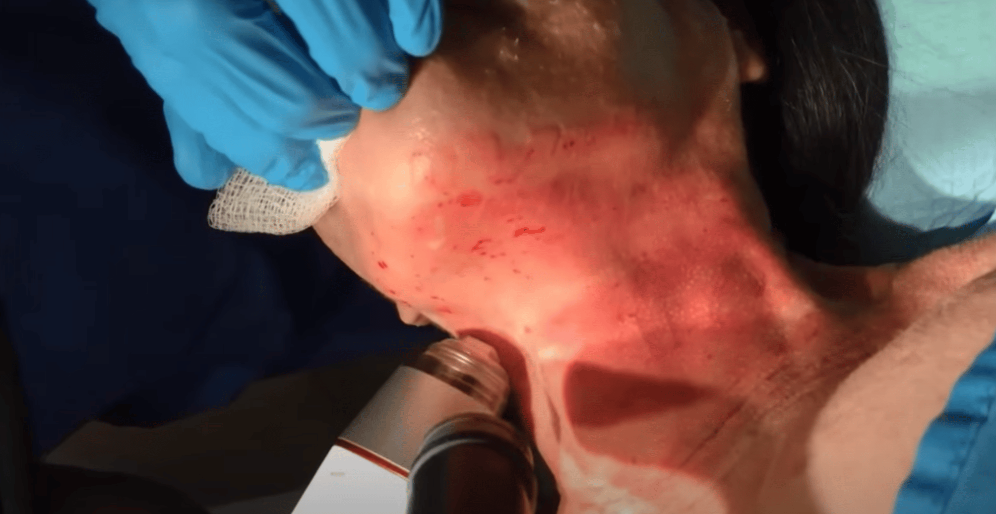 rf microneedling treatment process rf microneedling treatment process