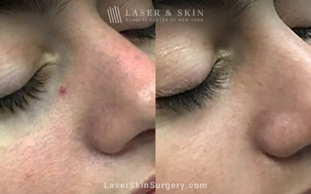 Laser treatment to remove broken blood vessel