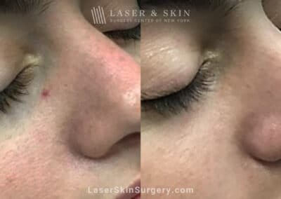 Laser treatment to remove broken blood vessel