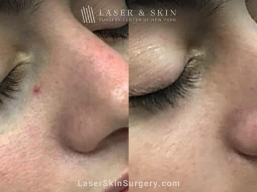 Laser treatment to remove broken blood vessel