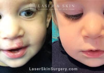 Laser treatment for hemangioma above lip