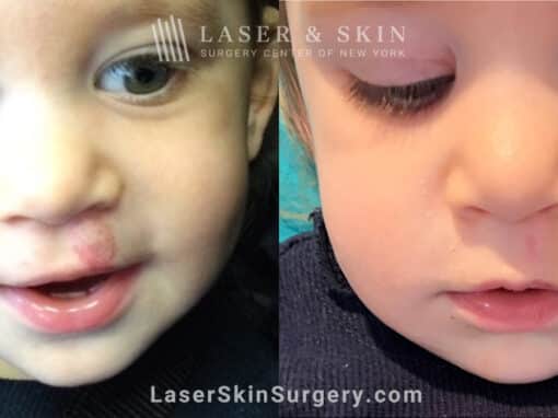 Laser treatment for hemangioma above lip