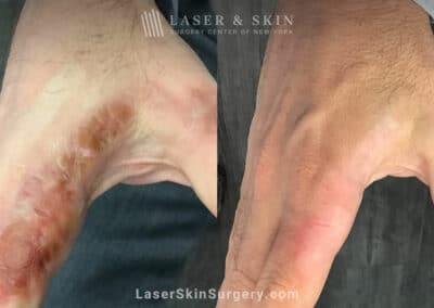 Laser treatment for scarring on the hand