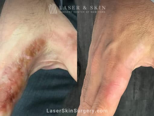 Laser treatment for scarring on the hand