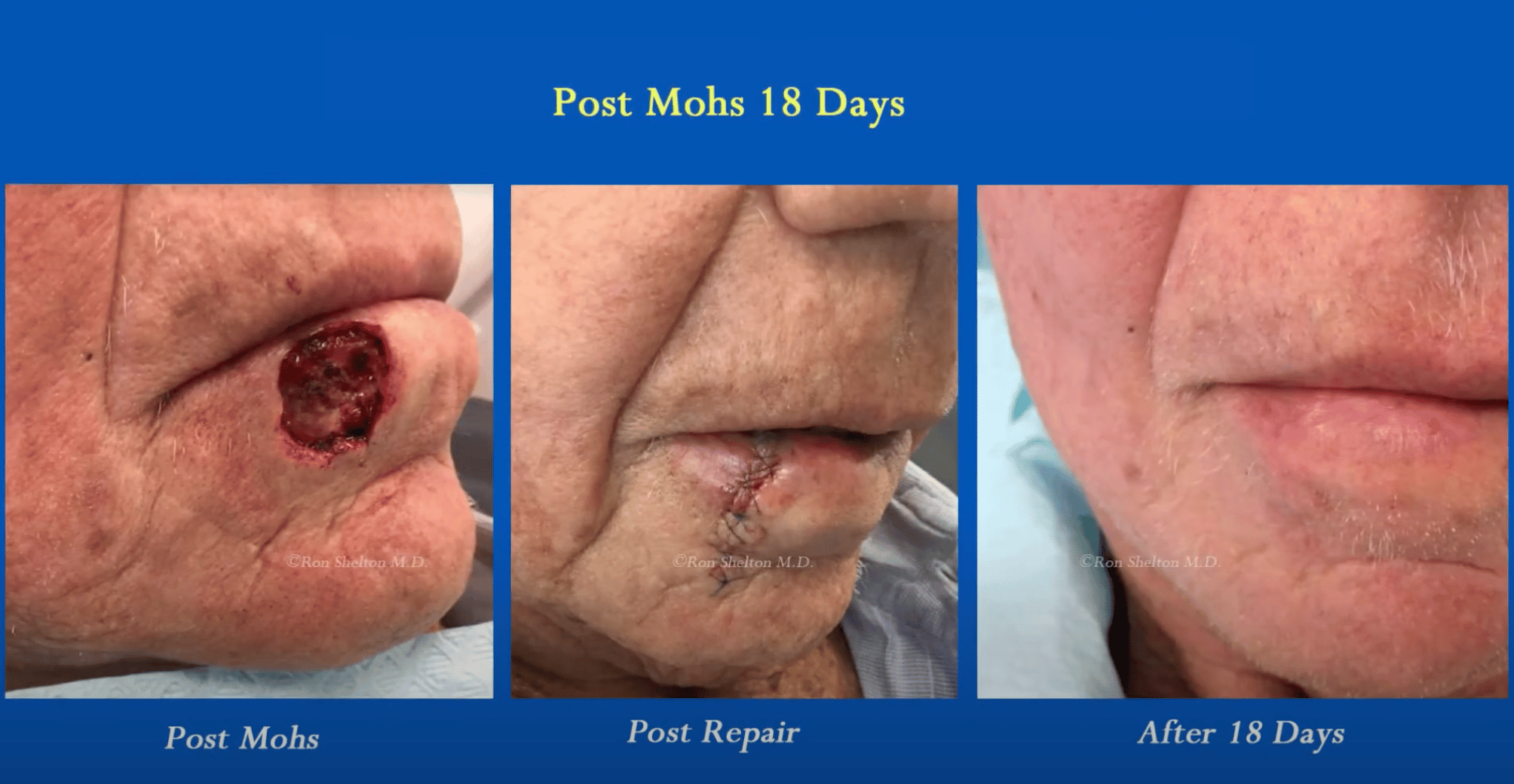 Mohs Micrographic Surgery for skin cancer treatment in nyc