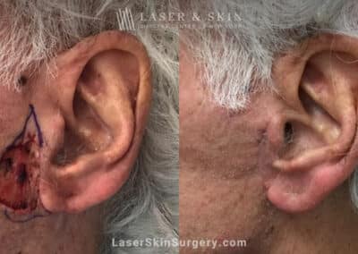 Mohs Surgery to Treat Skin Cancer on Ear
