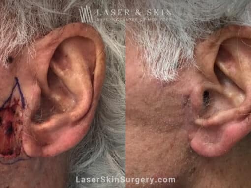 Mohs Surgery to Treat Skin Cancer on Ear