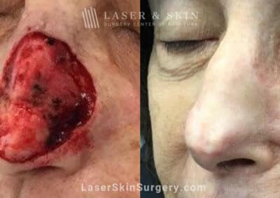 Mohs surgery to treat skin cancer on nose
