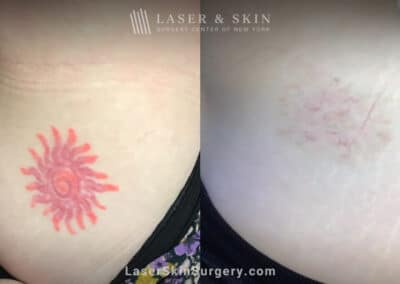 Laser Treatment For the Removal of a Red Colored Tattoo