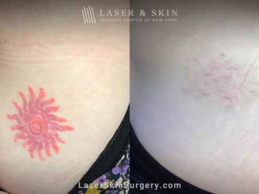 Laser Treatment For the Removal of a Red Colored Tattoo