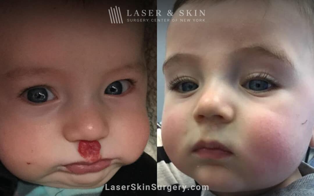 Pulsed Dye Laser to treat Hemangioma above Lip