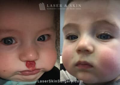 Pulsed Dye Laser to treat Hemangioma above Lip
